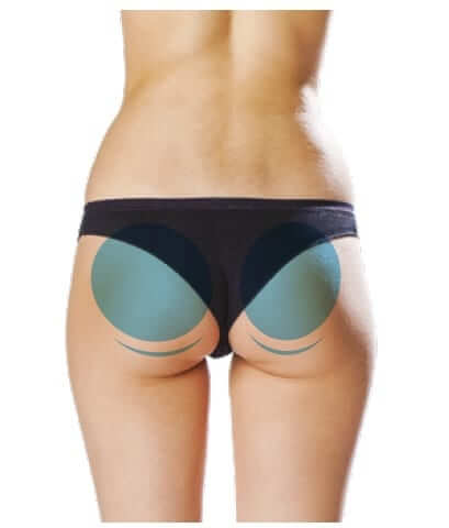 non surgical bum lift wigan