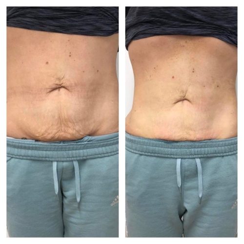 Skin Tightening in Southport - Permanent Perfection Aesthetics