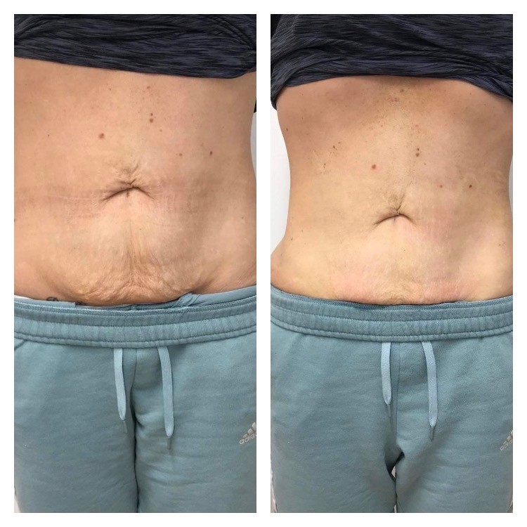 Does Nonsurgical Skin Tightening Work on Loose Skin Around the Waist?