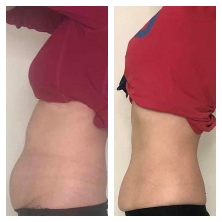 Non-Surgical Belly Fat Removal